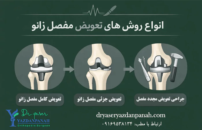 انواع روش های تعویض مفصل زانو در ماهشهر