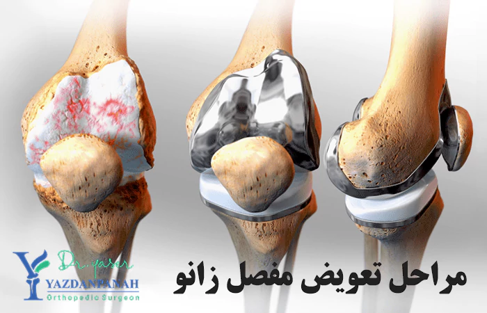 مراحل تعویض مفصل زانو در ماهشهر چیست؟